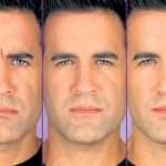 botox