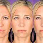 botox2