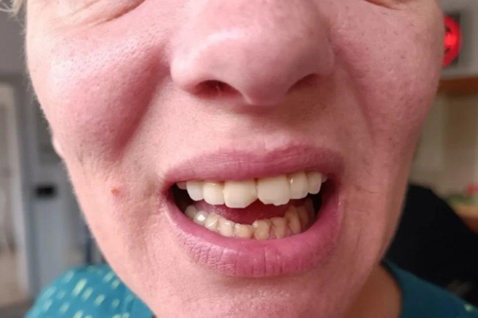 Spikerici iz Dubrovnika tijekom pregleda polomljena dva zuba i ozlijeđena usna šupljina